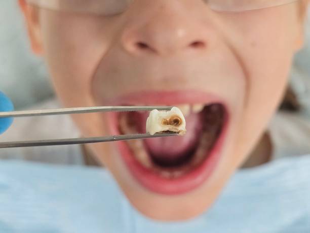 Best Emergency Dental Care for Broken or Chipped Teeth in Locust Grove, GA